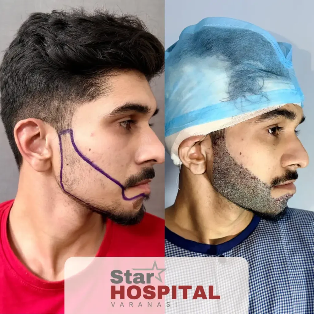 Before after results of the best beard transplant in varanasi performed by top plastic surgeon Dr. Gautam Prakash at Star Hospital Akhri Bypass.